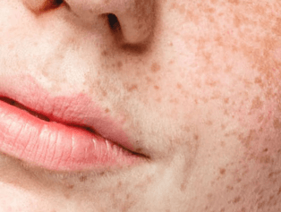 Cosmetics for skin discoloration
