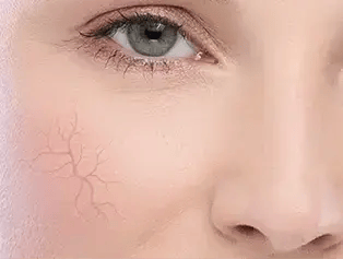 Cosmetics for vascular skin with rosacea
